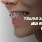 Instagram Captions For When You Get Your Braces Off
